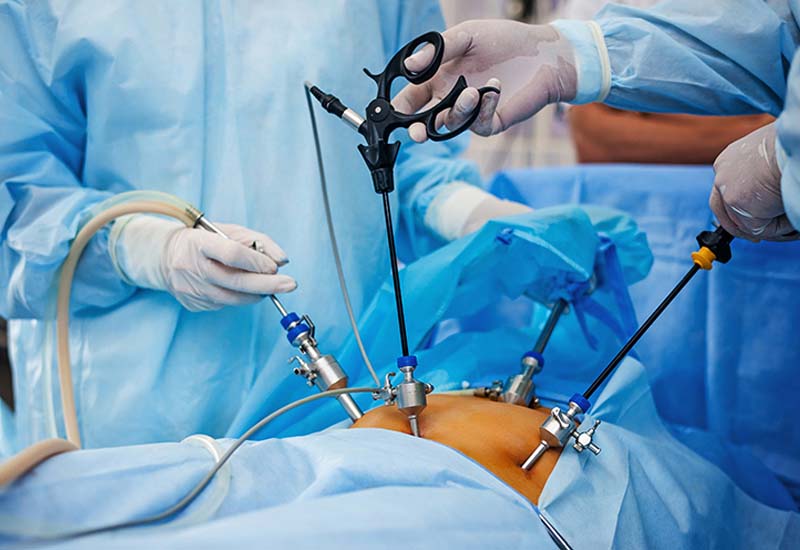 Gallstones Laparoscopic Cholecystectomy
