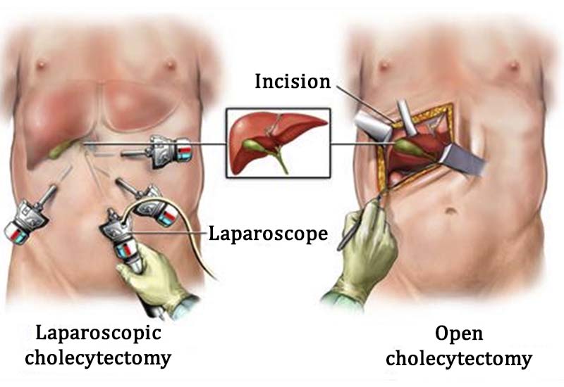 Gallstones Laparoscopic Cholecystectomy