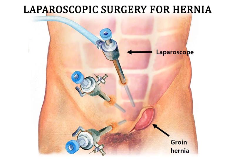 hernia