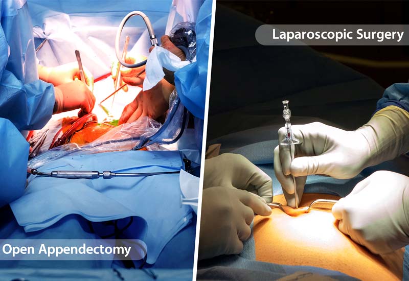 Laparoscopic Appendix